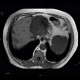Cholangiocellular carcinoma of liver, dilation of intrahepatic ducts: MRI - Magnetic Resonance Imaging